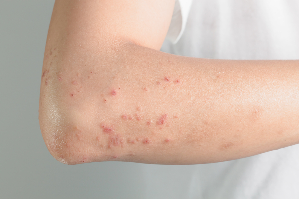 What You Need To Know About Shingles
