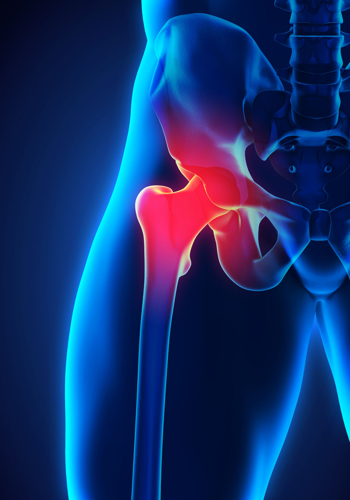 Hip Replacement Surgery and What to Expect After the Procedure
