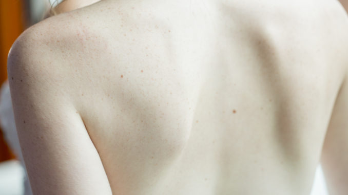 shoulder pain